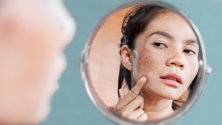 Banishing Pigmentation Woes: Your Comprehensive Guide to Clearer Skin